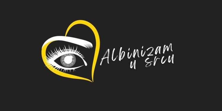 Sve o albinizmu s Anom Samaržijom